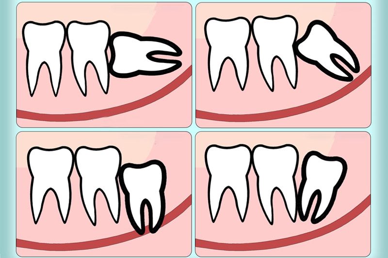 Răng khôn mọc lệch mọc xiên sẽ phải nhổ bỏ để ngăn ngừa biến chứng
