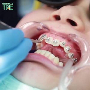 Quy trình niềng răng mắc cài diễn ra tuần tự như thế nào?