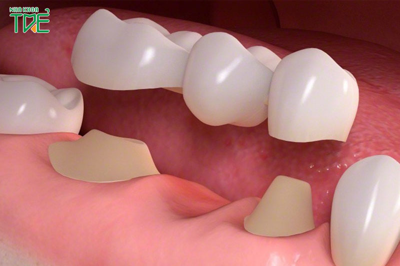 Trồng răng sứ phục hình răng bị mất hiệu quả