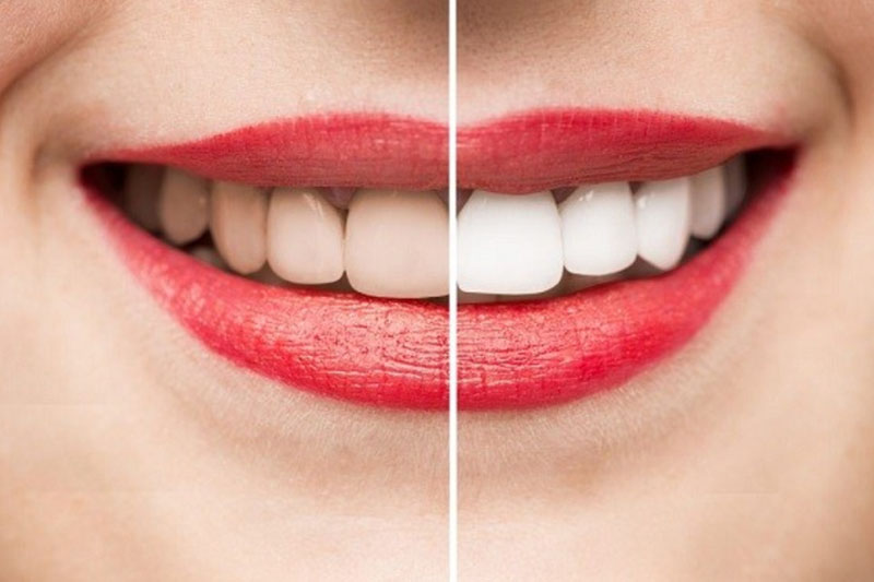 Chăm sóc răng miệng đúng cách giúp răng trắng sáng, tăng thẩm mỹ khuôn mặt