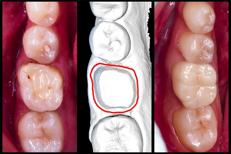 Bọc răng sứ phục hình răng cấm bị vỡ vẫn còn chân răng