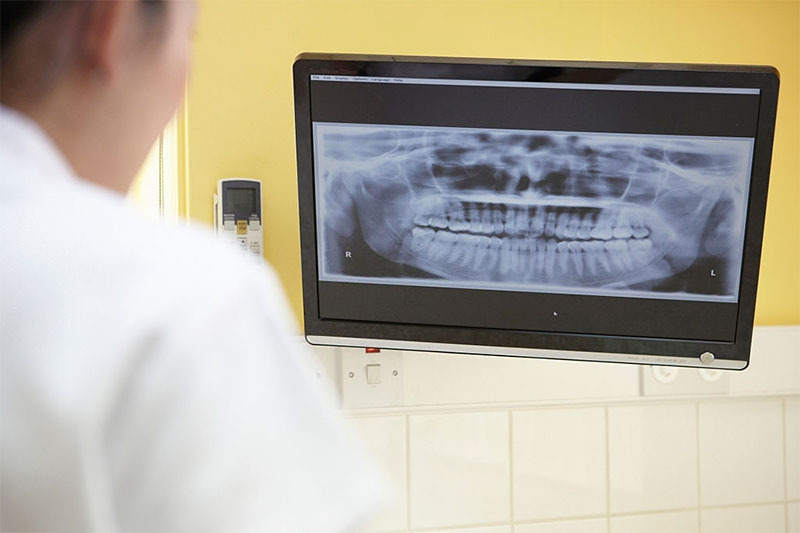 Số chân răng cấm sẽ được xác nhận chính xác dựa vào ảnh chụp X-quang răng