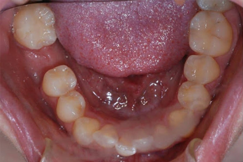 Răng cấm chỉ mọc 1 lần duy trì trong đời