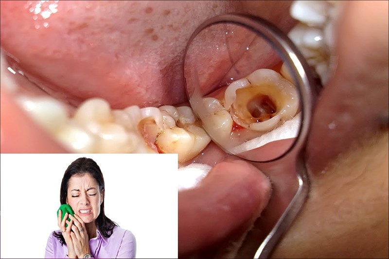 Bắt buộc nhổ răng cấm khi răng bị sâu hoặc viêm tủy, viêm nha chu nặng