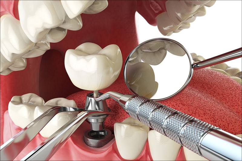 Cấy ghép Implant là phương pháp phục hình răng mất hiện đại nhất hiện nay