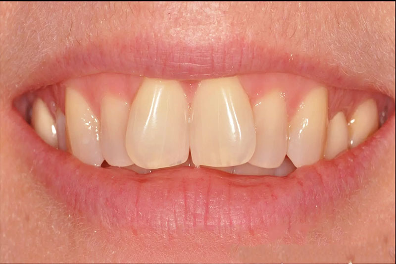 Răng cửa hình chữ V có thể có kích thước lớn hơn các răng khác