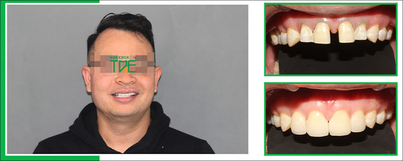 Bọc răng sứ cải thiện hình thể của răng thưa