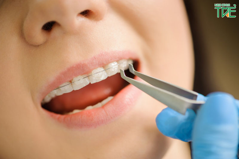 Review niềng răng mắc cài sứ: Những kinh nghiệm khi niềng răng