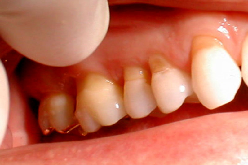 Chân răng bị tác động nhiều sẽ dẫn đến mòn chân răng