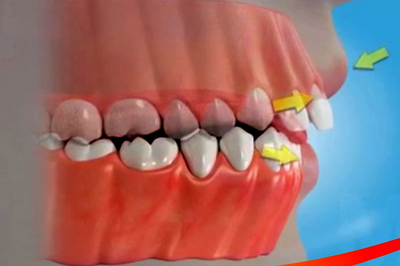 Thói quen xấu ảnh hưởng đến răng miệng như đẩy lưỡi rất khó phát hiện