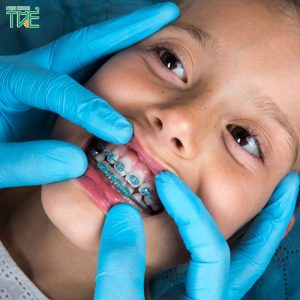 Trẻ em mấy tuổi thì niềng răng được? Phương pháp nào phù hợp nhất?