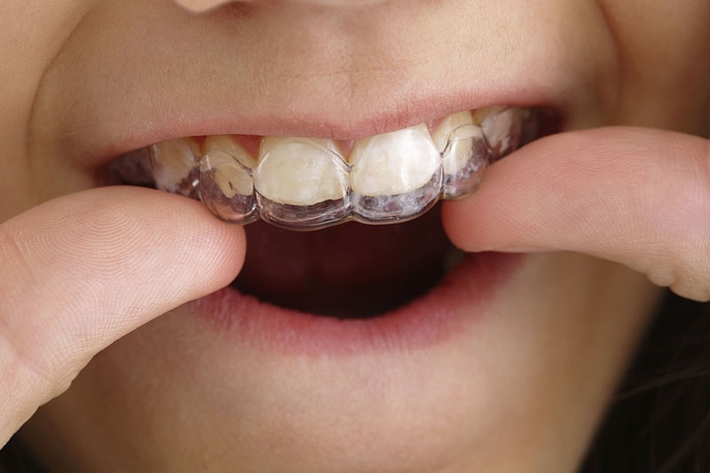 Niềng răng trong suốt Invisalign mang nhiều ưu điểm nổi bật