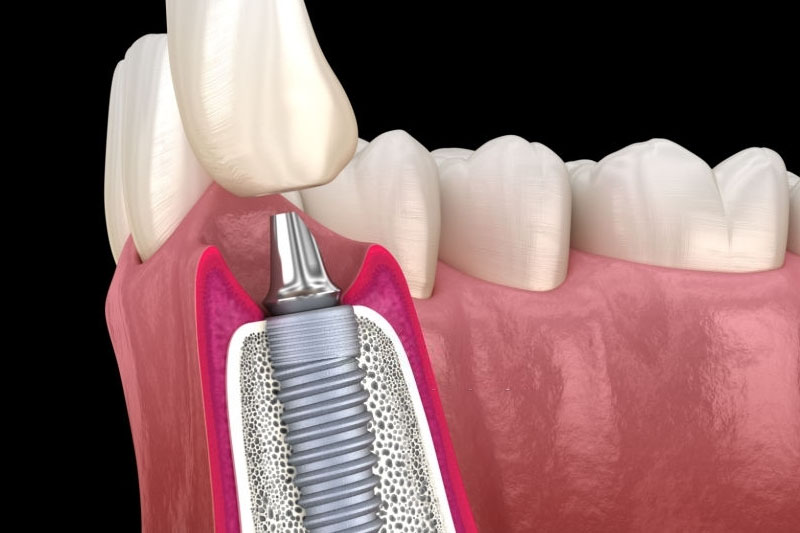 Trồng răng Implant phục hình răng tương tự như răng thật