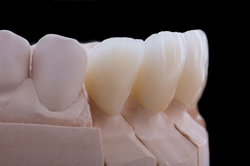 Cầu răng sứ gồm ít nhất 3 mão răng sứ để phục hình răng mất