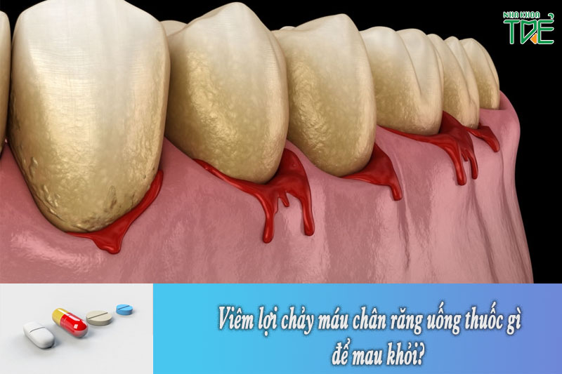 Viêm lợi chảy máu chân răng uống thuốc gì để mau khỏi?