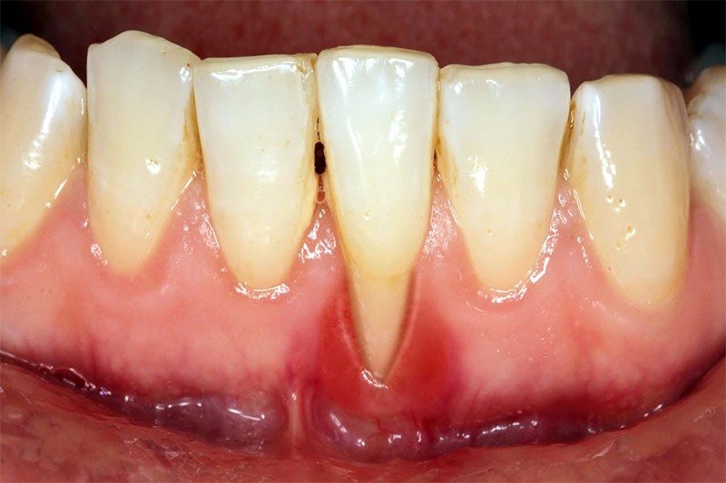 Dấu hiệu nhận biết viêm chân răng cần chữa trị kịp thời