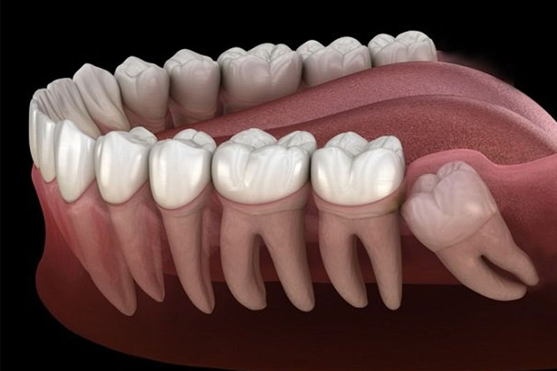 Răng khôn đa số mọc lệch, mọc ngầm gây hại cho sức khỏe răng miệng