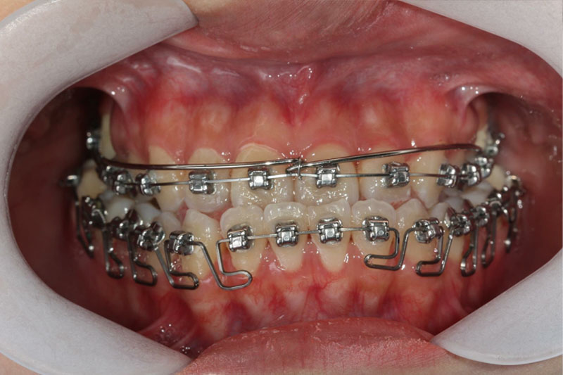 Chữa răng móm nhẹ bằng phương pháp niềng răng, không cần phẫu thuật