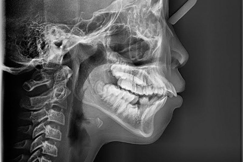 Các trường hợp răng hô có thể do răng hoặc do xương