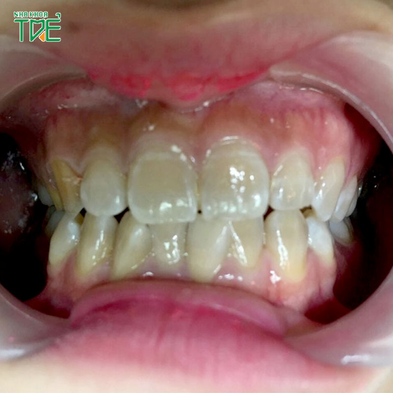 Có nên phục hình răng nhiễm Tetracycline? Phương pháp phục hình nào tốt nhất?