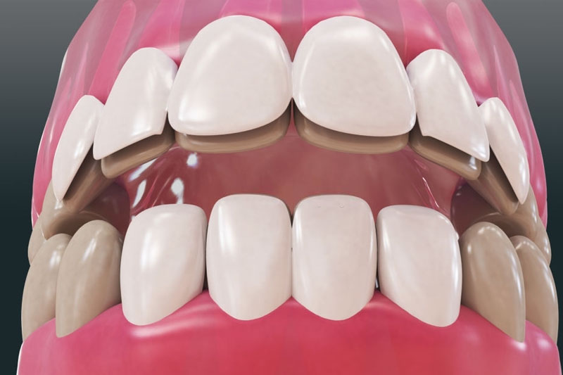 Dán răng sứ hạn chế xâm lấn cho răng nhiễm kháng sinh