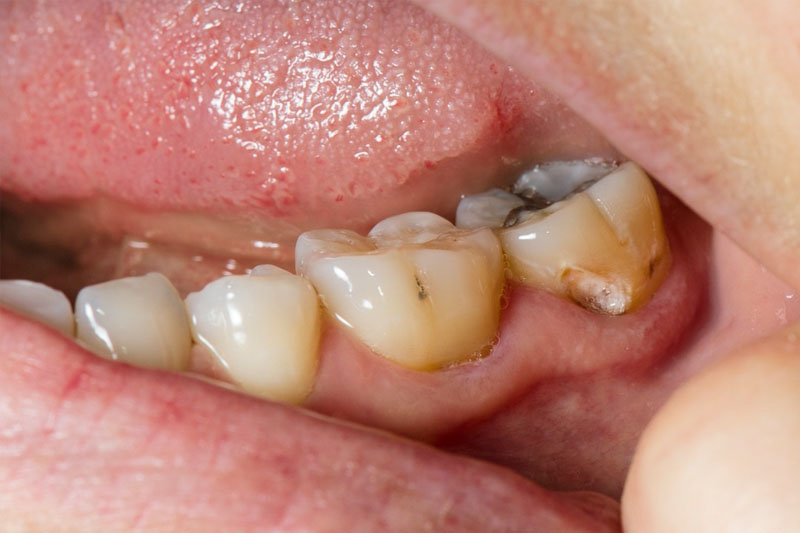 Sâu răng, viêm tủy gây đau nhức dữ dội