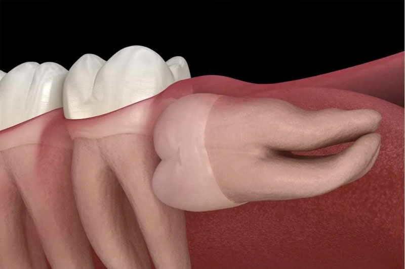 Răng khôn thường mọc lệch, mọc ngầm gây đau nhức và nhiều biến chứng khác