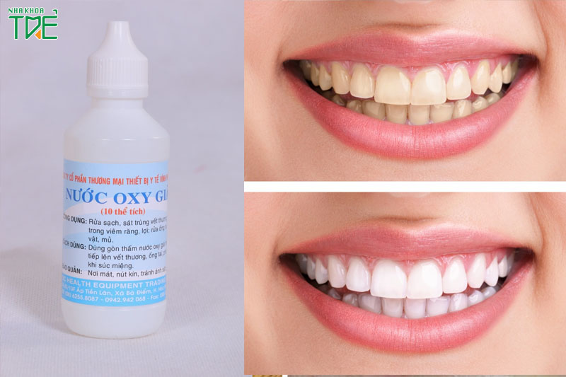 Làm trắng răng bằng oxy già: Liệu có mang lại hiệu quả?