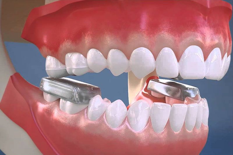 Sử dụng khí cụ chuyên dụng để nâng khớp cắn khi niềng răng