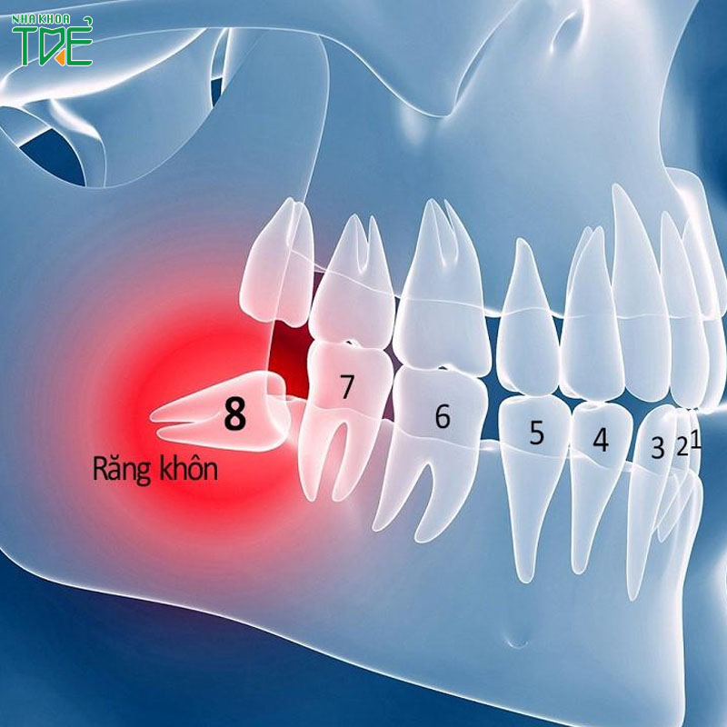 Nhổ răng số 6, 7, 8 gây ảnh hưởng gì? Nên trồng răng bằng phương pháp nào?