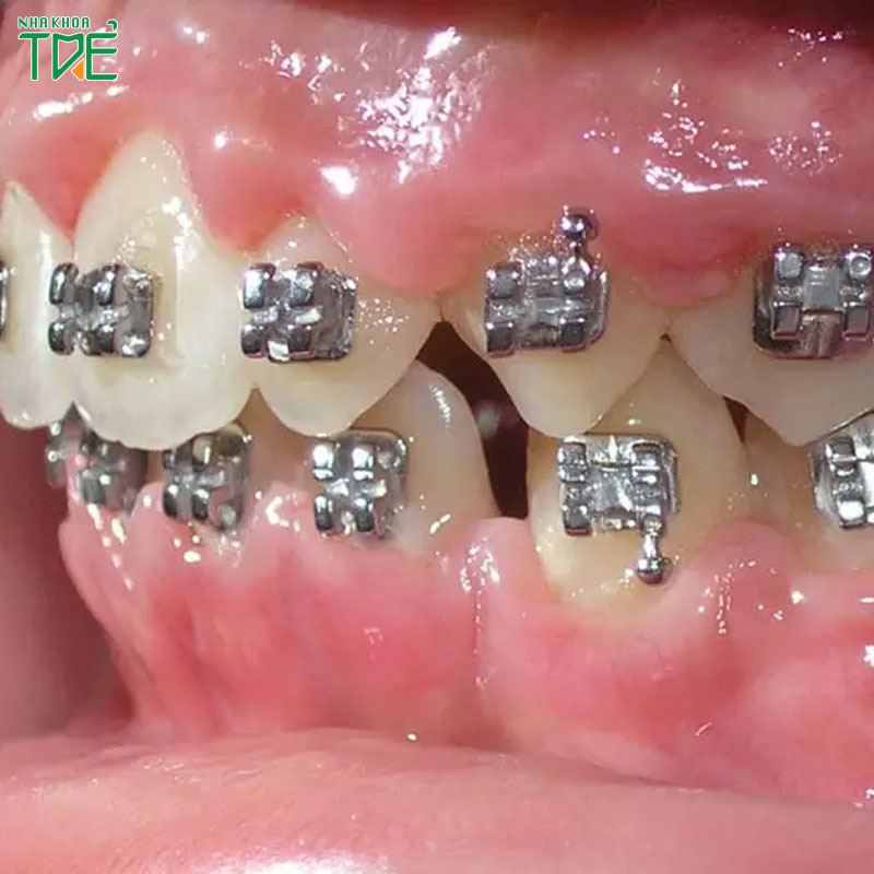 Niềng răng không thành công: Dấu hiệu nhận biết và cách khắc phục là gì?