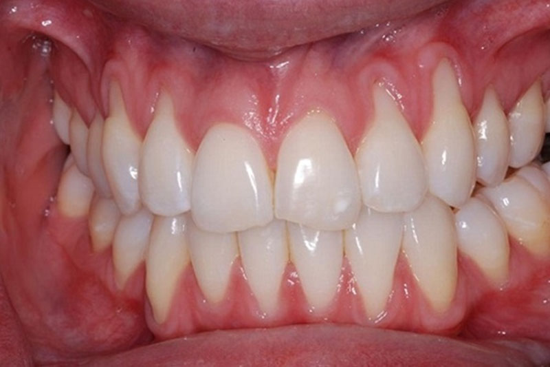 Biến chứng niềng răng không thành công là tình trạng tụt lợi, tụt nướu nghiêm trọng
