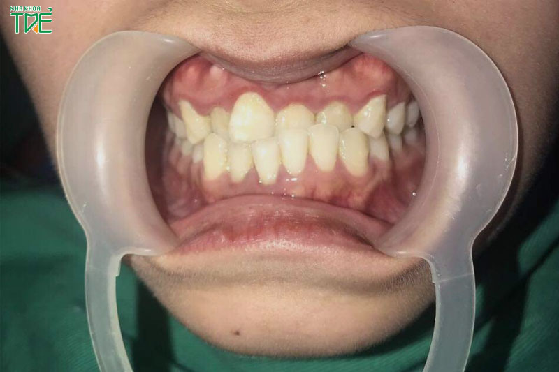 Niềng răng móm trong bao lâu thì có hiệu quả?