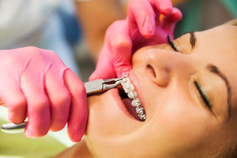 Niềng răng móm trong bao lâu thì có hiệu quả?