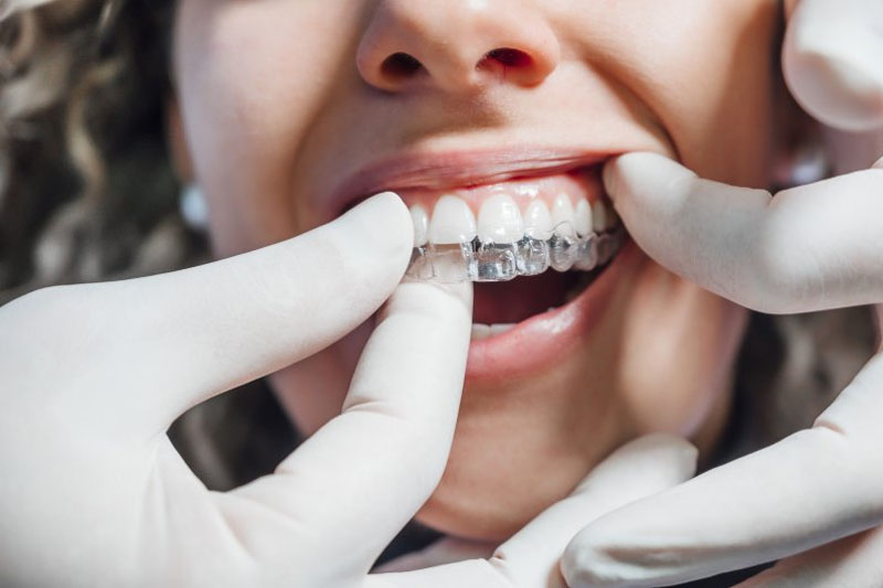 Máng trong suốt Invisalign giá bao nhiêu phụ thuộc vào tình trạng răng của từng người