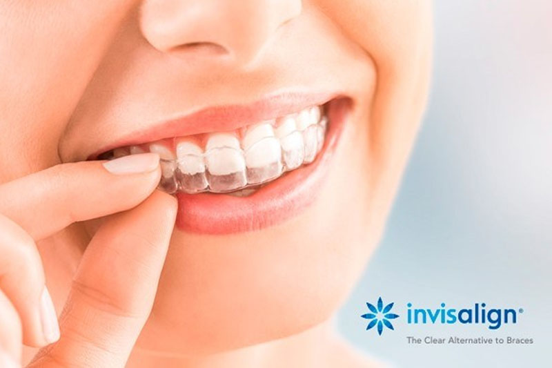 Invisalign - giải pháp niềng răng hiện đại bậc nhất với nhiều ưu điểm vượt trội