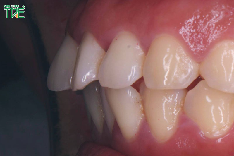Răng hô nặng có niềng răng được không? Giải pháp nào tốt nhất?