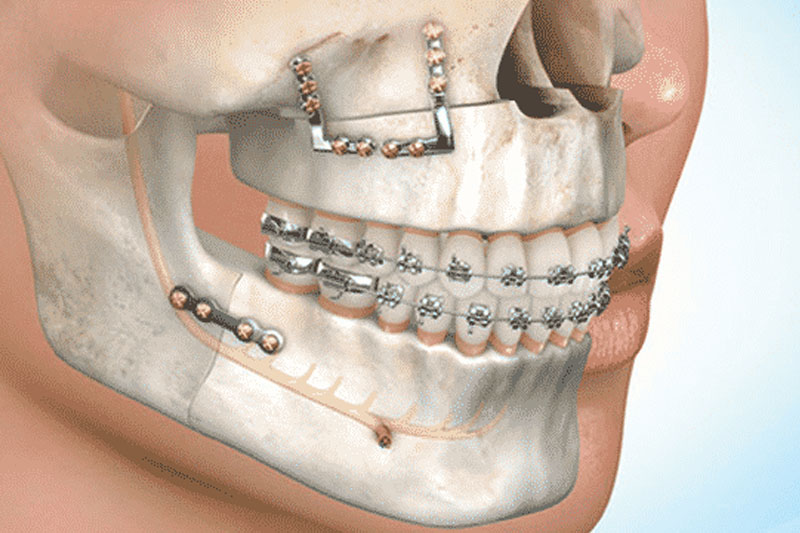 Niềng răng kết hợp phẫu thuật hàm trong trường hợp hô nặng do cả răng và xương hàm