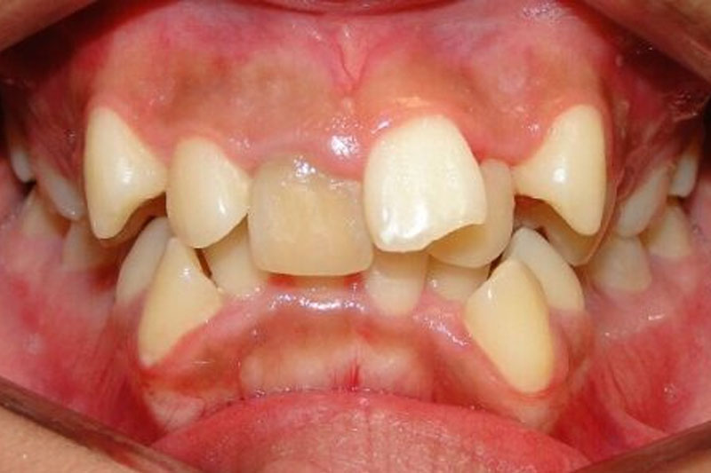 Răng bị sai khớp cắn sẽ làm lệch nhân trung