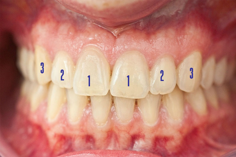 Các răng được đánh số thứ tự từ 1 - 8 tính từ vị trí răng cửa