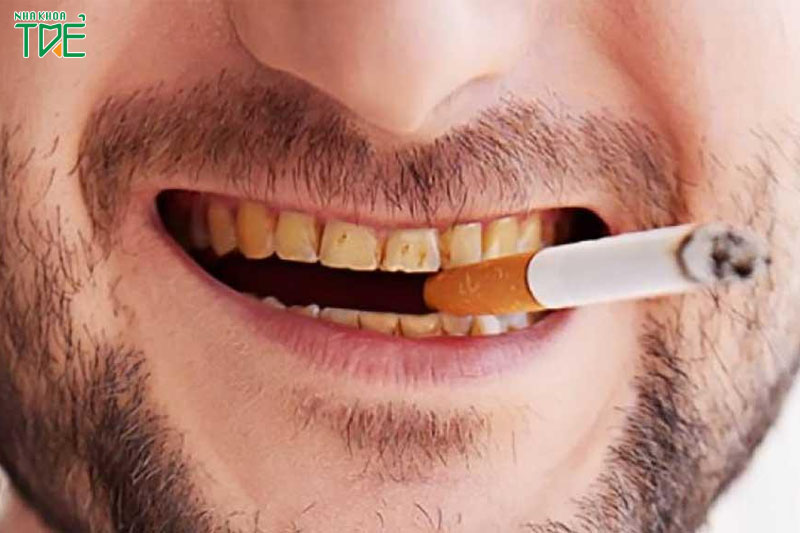 Hút thuốc lá có các độc tố tác động xấu đến răng miệng