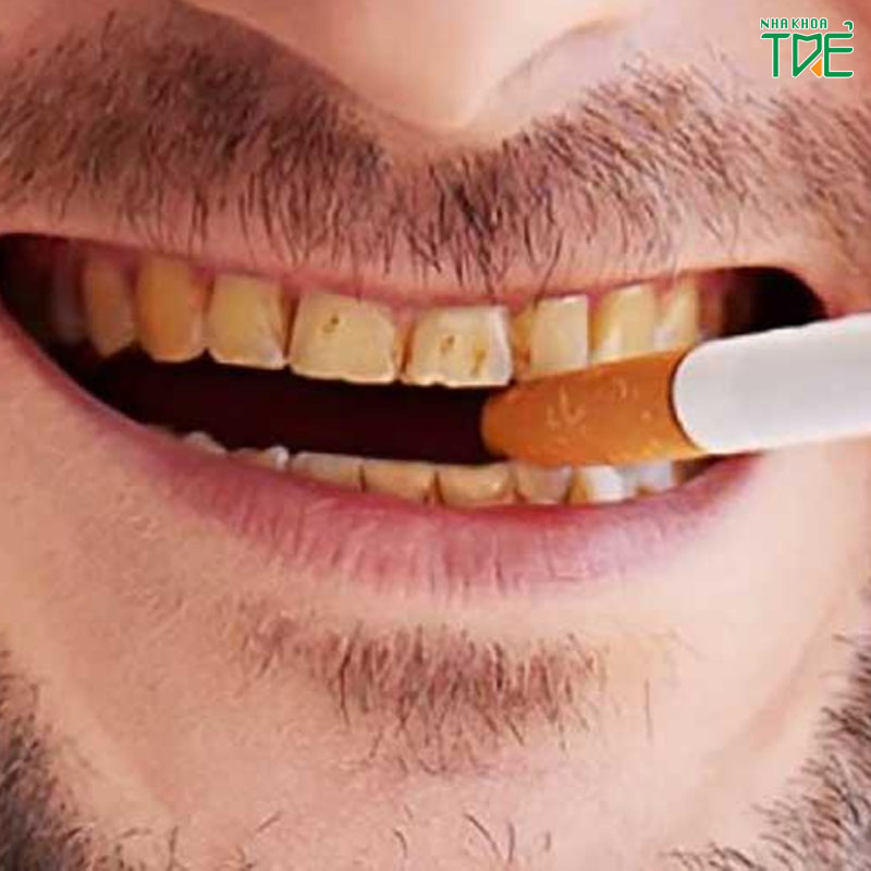Tẩy trắng răng cho người hút thuốc lá có hiệu quả không?