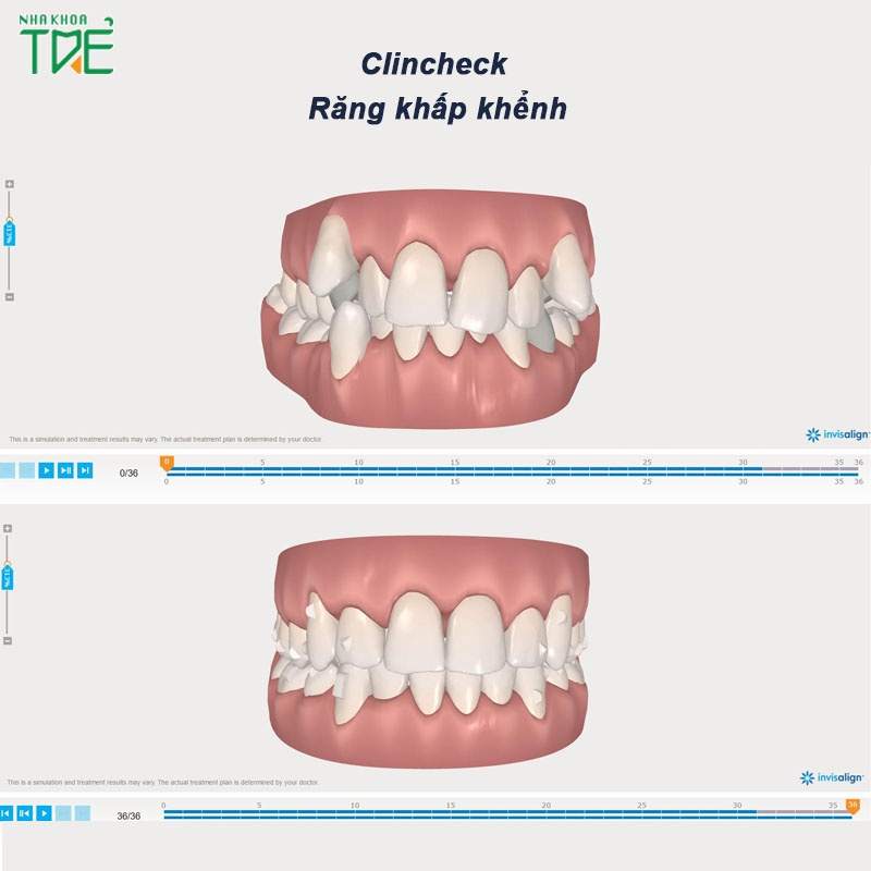 Clincheck là gì? Ứng dụng Video Clincheck 3D trong niềng răng Invisalign