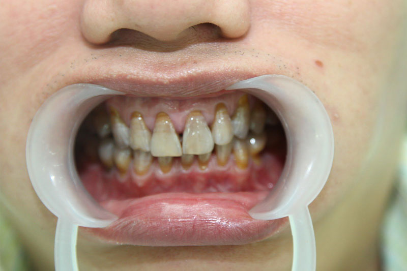 Thuốc Tetra có tác dụng chữa bệnh nhiễm khuẩn nhưng có tác dụng phụ làm răng bị ố vàng, xỉn màu