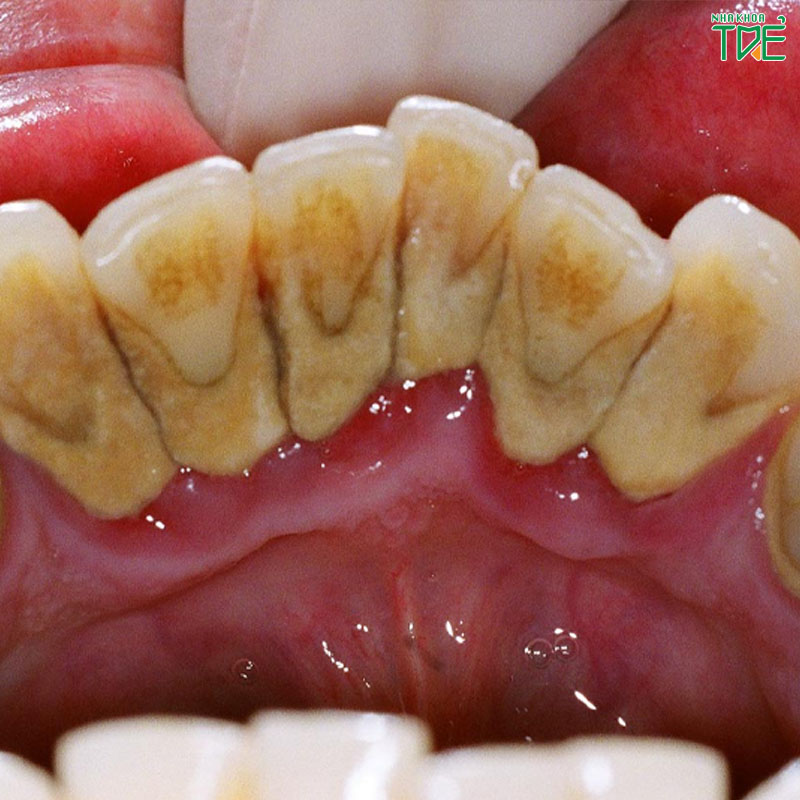 Cao răng nhiều phải làm sao để khắc phục triệt để?