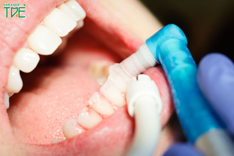 Đánh bóng răng có hại không? Những điều cần lưu ý khi đánh bóng răng