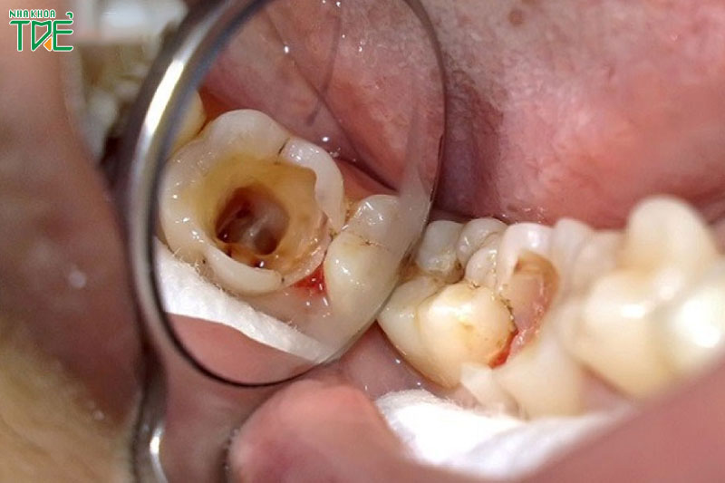 Diệt tủy răng là chỉ định bắt buộc khi tủy răng bị viêm nhiễm, hoại tử