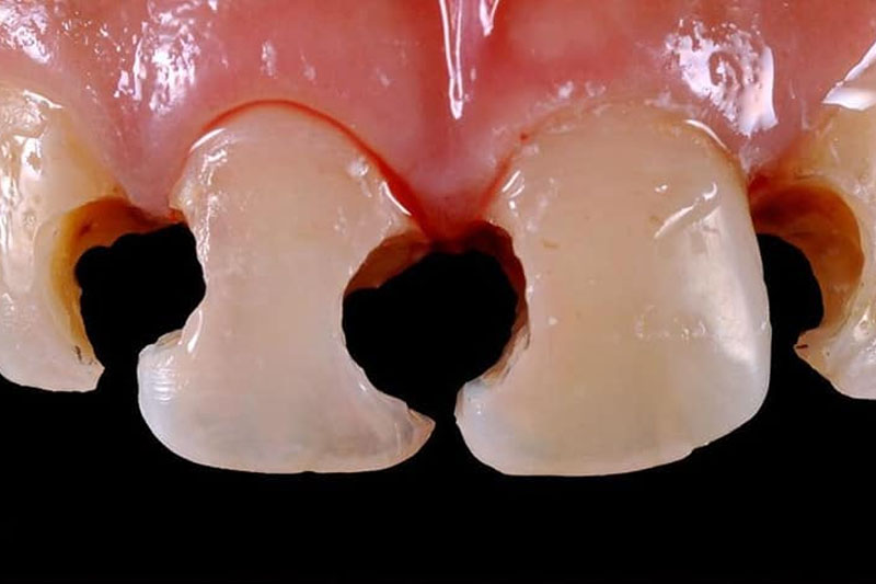 Sâu răng khiến răng dần suy yếu, răng lung lay và gãy vỡ