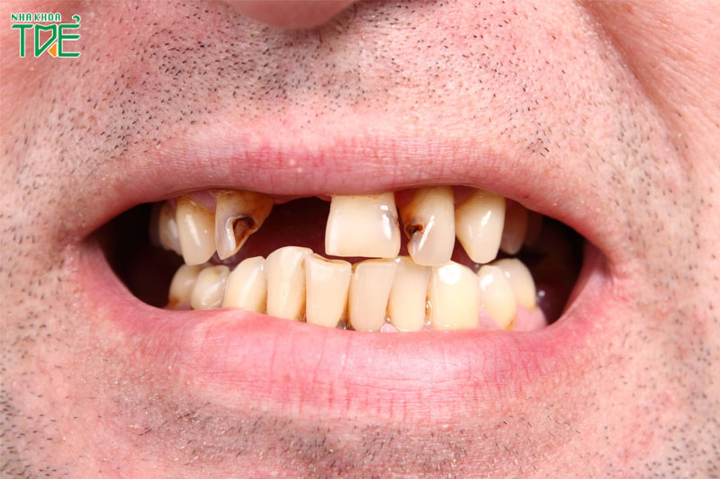 Hậu quả của việc mất răng lâu năm biểu hiện bên ngoài là tình trạng mất thẩm mỹ nghiêm trọng