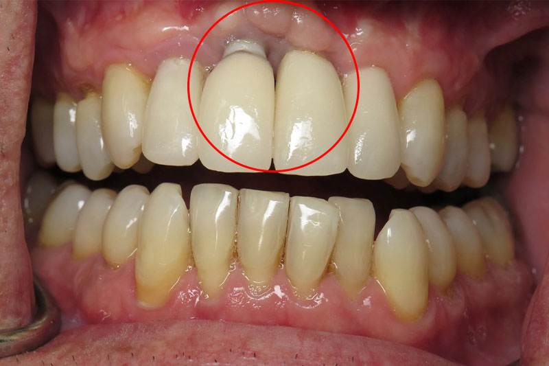 Cầu răng sứ không ngăn ngừa được hoàn toàn biến chứng tiêu xương hàm